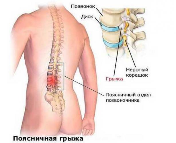 Запущенные формы грыжи ведут к крайне тяжелым последствиям