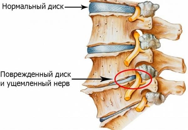 Возникнуть патология может из-за иных заболеваний позвоночника