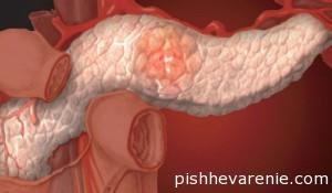 Панкреатит - основная причина боли поджелудочной железы