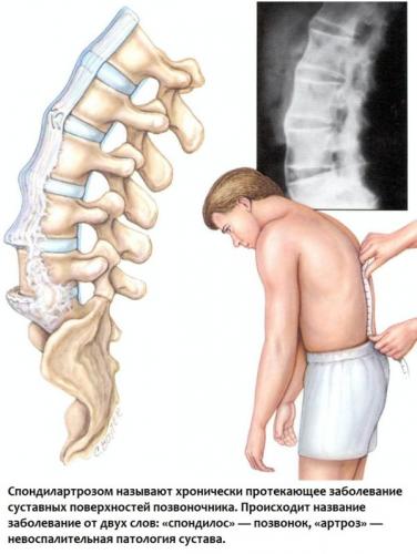 Деформирующий спондилоартроз