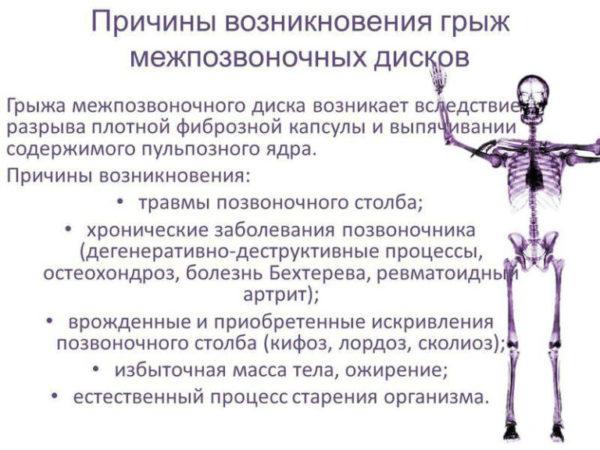 Причины возникновения межпозвоночных грыж