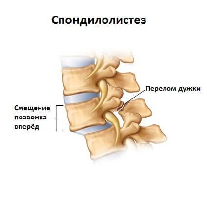 Спондилолистез 