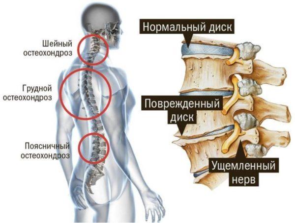 Остеохондроз позвоночника