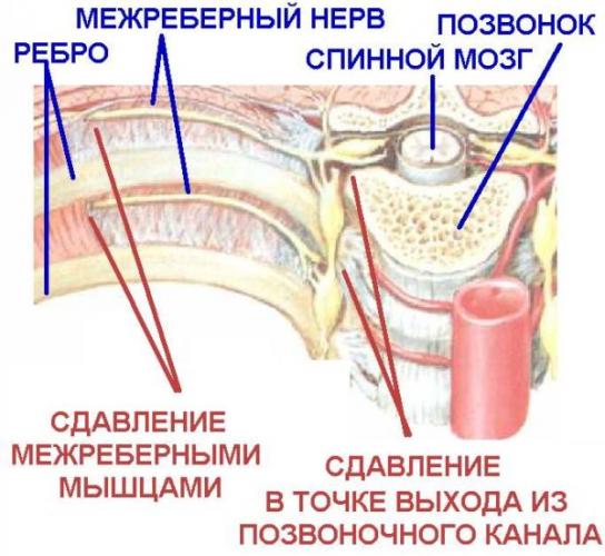 Защемление нерва при межреберной невралгии