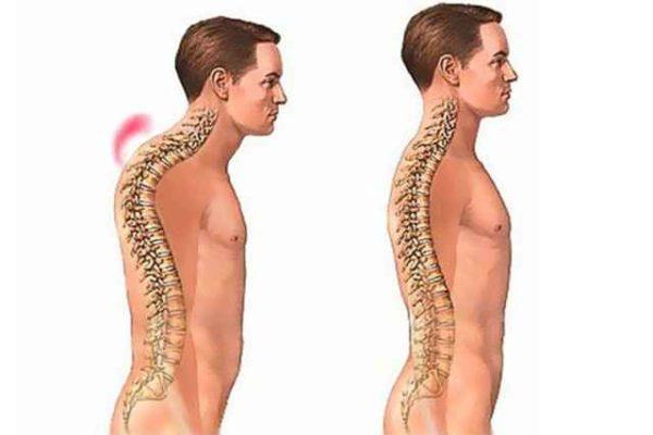 К первым характерным проявлениям болезни относятся сутулость и боли в спине