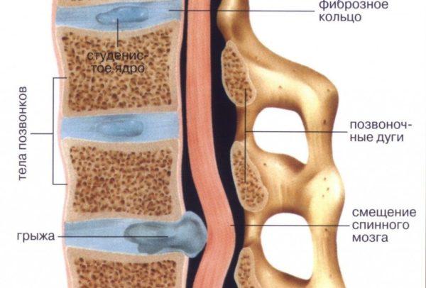 Межпозвоночная грыжа
