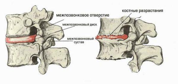 Остеофиты