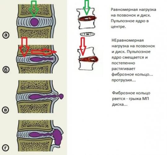 Механизм образования грыжи межпозвоночных дисков