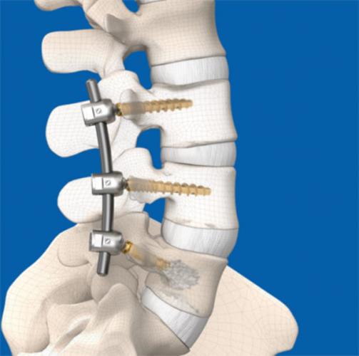 Транспедикулярная фиксация позвоночника
