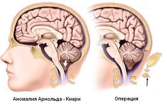 Аномалия Арнольда-Киари