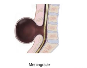 Менингоцеле