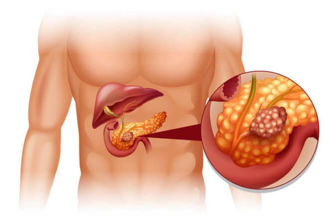 Рак поджелудочной