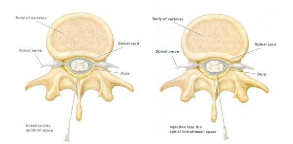 Слева – инъекция в эпидуральное пространство