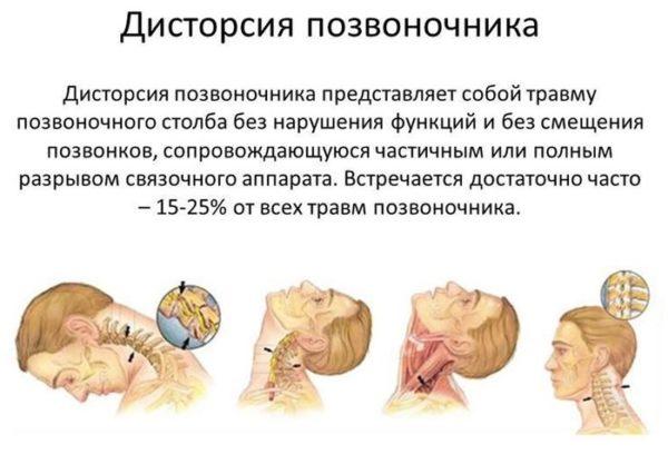 Дисторсия позвоночника