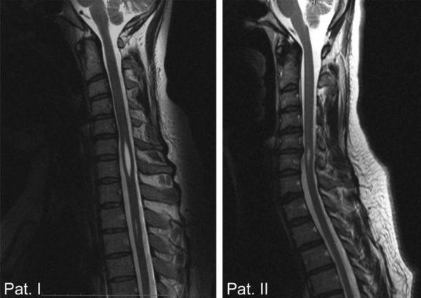 Сирингомиелия шейного и грудного отделов позвоночника