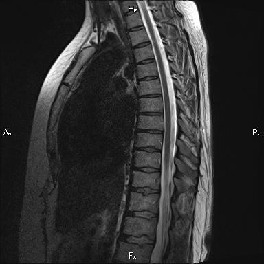 МРТ грудного отдела позвоночника 