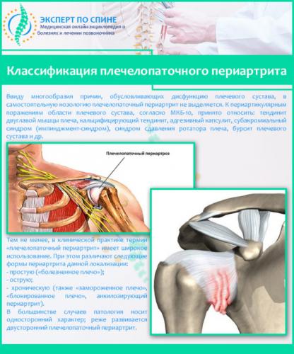 Классификация плечелопаточного периартрита