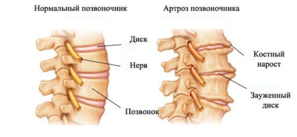 Артроз позвоночника