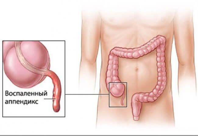 Воспаление аппендицита