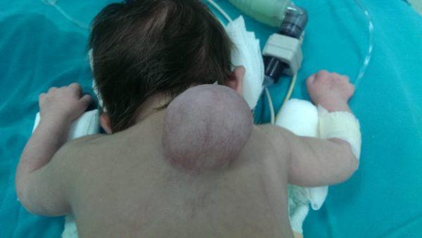 Spina Bifida - Meningosel