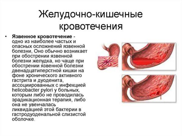 Желудочно-кишечное кровотечение