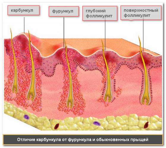 Отличие карбункула от фурункула