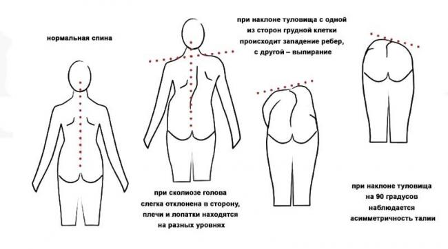 Признаки сколиоза