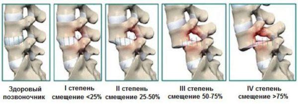 Антелистез - стадии