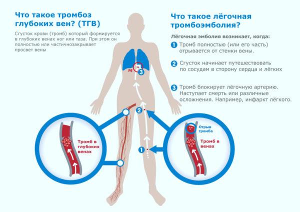 Тромбоз