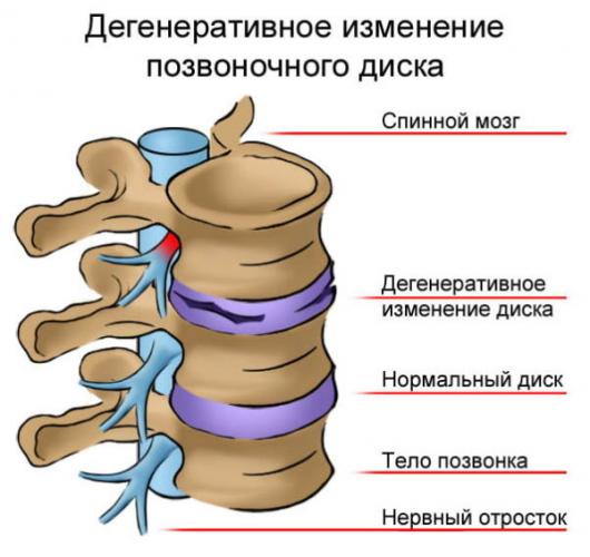 Остеохондроз поясничного отдела