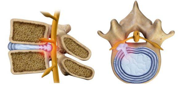 Грыжа позвоночника