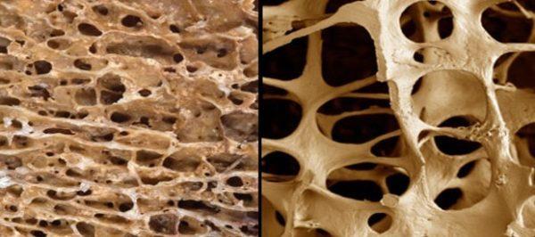 Повышенный риск развития остеопороза относится к основным показаниям для денситометрии