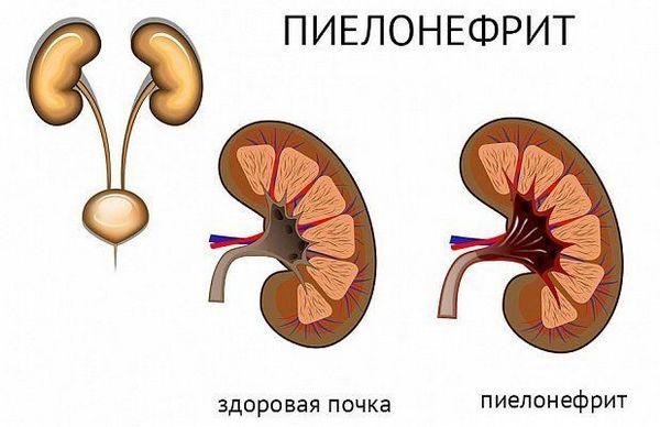 Пиелонефрит – одно из заболеваний внутренних органов, которое создаёт условия для развития пульсирующей боли в поясничном отделе