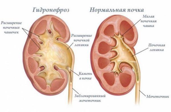 Гидронефроз почки