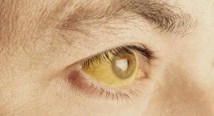 От чего желтеют глаза