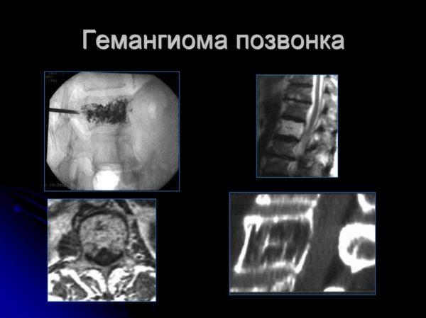 Гемангиолипомы в позвоночнике