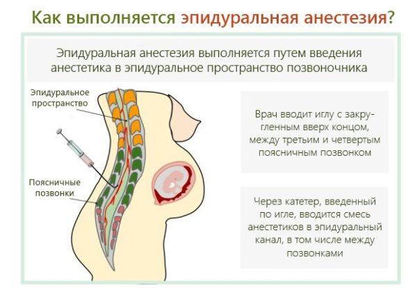 Как выполняется эпидуральная анестезия при родах