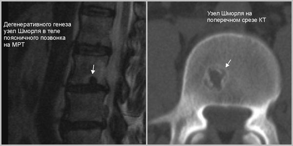 Единичный узел Шморля в области каудальной замыкательной пластинки тела поясничного позвонка, а так же узел Шморля в поперечном срезе на КТ в виде округлого дефекта замыкательной пластики