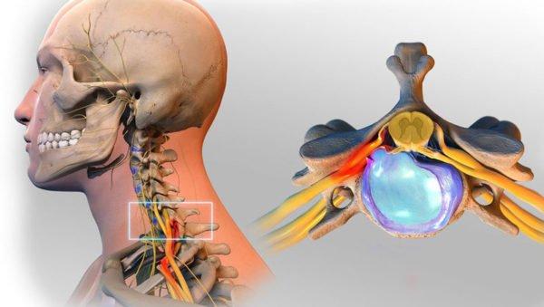 Грыжа шейного отдела