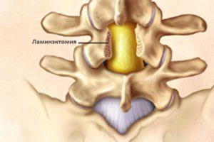 Ламинэктомия