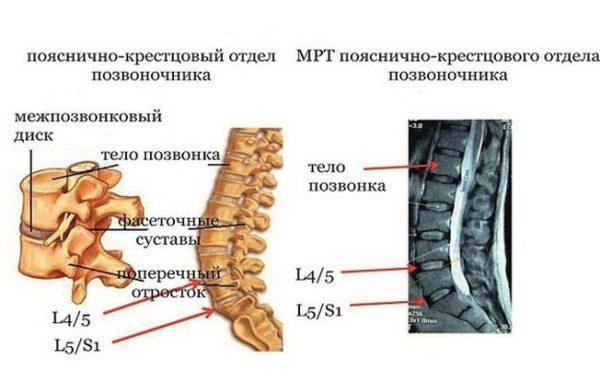 МРТ пояснично-крестцового отдела позвоночника