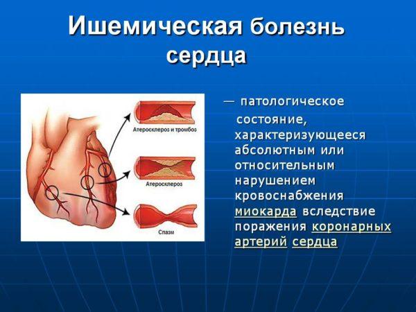 Ишемическая болезнь сердца
