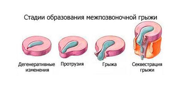 Формирование грыжи позвоночника