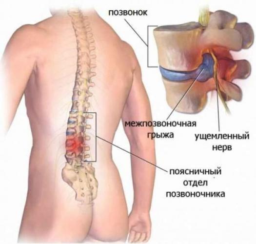 Межпозвоночная грыжа