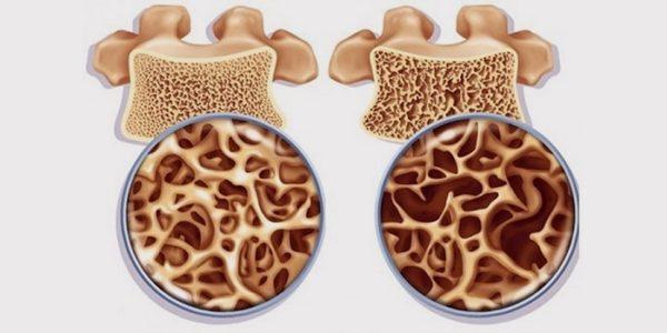 Остеопороз — опасный недуг, который в народе также известен как болезнь хрупкости костей