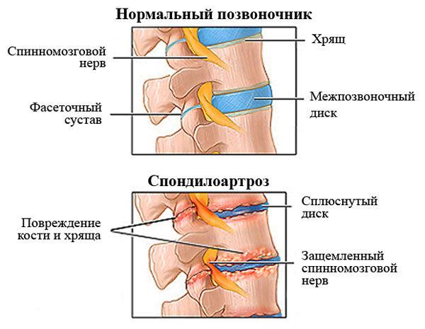 На фоне грыжи Шморля может развиться спондилоартроз