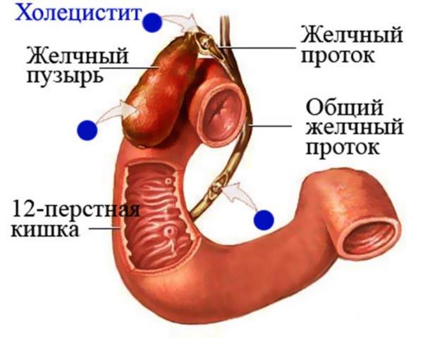 Холецистит