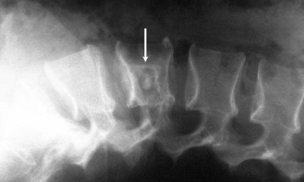 Грыжа Шморля на рентгенограмме