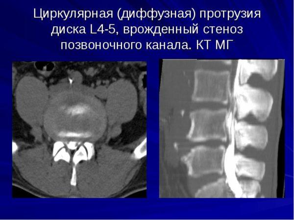 Циркулярная (диффузная) протрузия