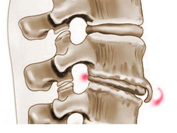При спондилезе формируются остеофиты – костные наросты